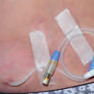 Tenckhoff Peritoneal Dialysis Catheter