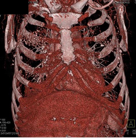Faint Calcification In The Chest Wall Chest Case Studies Ctisus Ct