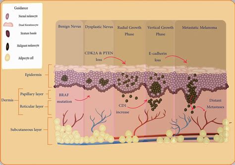 Melanoma Tumorgenesis And Related Genes Melanoma Tumor Progression Is