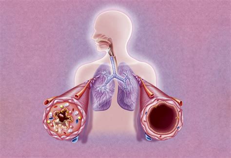 Rheumatoid Arthritis And Asthma Is There A Link Rheumatology Advisor