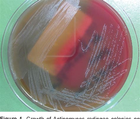 Figure 1 From A Breast Abscess Caused By Actinomyces Radingae