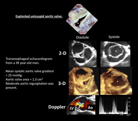 Discovery Of An Experimental Model Of Unicuspid Aortic Valve Journal