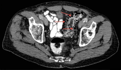 Colon Diverticulosis Diagnosis Dr Anastasios Christodoulou