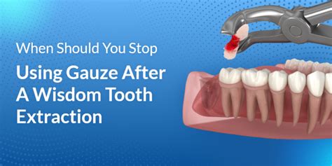 When Should You Stop Using Gauze After A Wisdom Tooth Extraction La