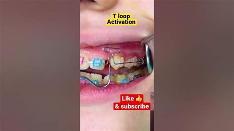 T Loop Activation Orthodontics Youtube