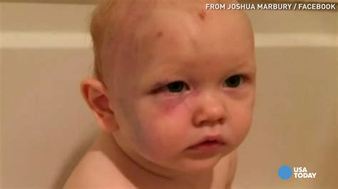 Badly Bruised Baby Caught In Legal Loophole