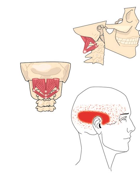 The Application Of Dry Needling Into Trigger Points Of Suboccipital And