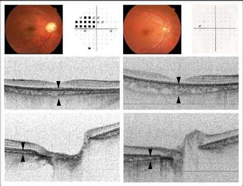 Figure From Evaluation Of The Choroidal Thickness Using High Penetration Optical Coherence