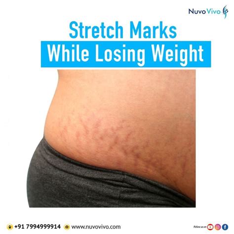Stretch Marks While Losing Weight Nuvovivo