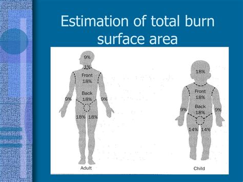 Ppt Paediatric Burns Powerpoint Presentation Free Download Id2956500