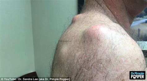 Dr Pimple Popper Bursts Mans 17 Year Old Cysts On His Back In Video