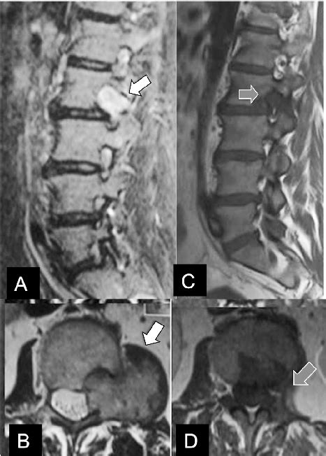 Lumbar Giant Spinal Schwannoma A Preoperative Sagittal T2 Weighted