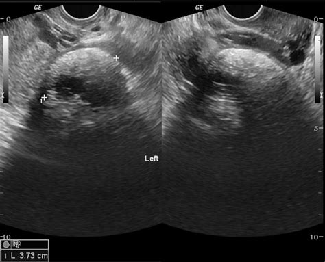 Dermoid Cyst Ultrasound Wikidoc