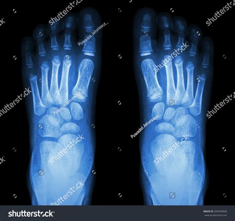 Xray Normal Childs Foots Stock Photo 200590958 Shutterstock