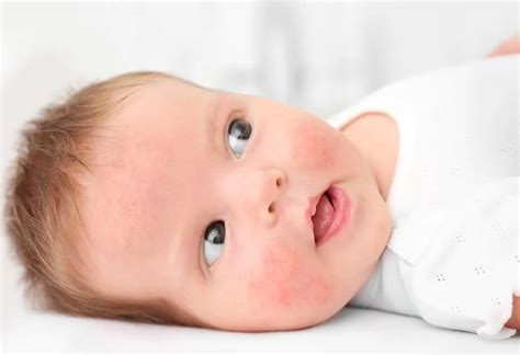 Wheat Allergy In Babies Signs And Tips To Handle It