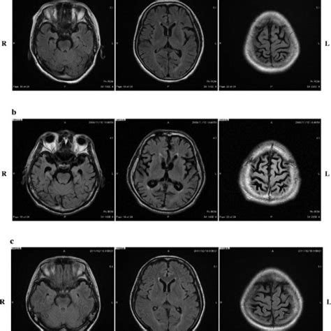 Brain Mri Flair A Iii 9 At The Age Of 55 Years B The Proband