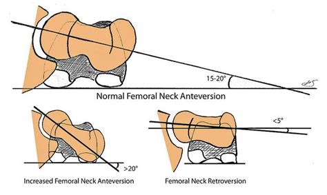 Femoral Anteversion Pediatrics Orthobullets