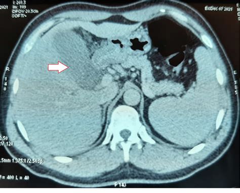 Figure 1 From Tuberculosis Or Gallbladder Carcinoma A Confusing