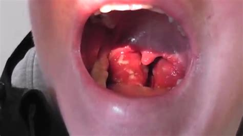 Tonsil Stones Or Tonsillitis Youtube
