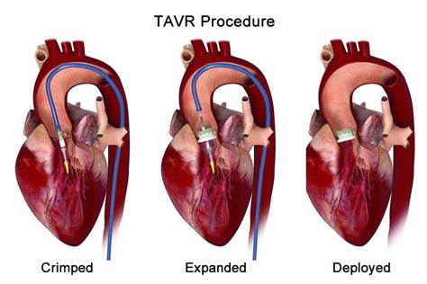 Tavr Transcatheter Aortic Valve Replacement Dr Tejas V Patel