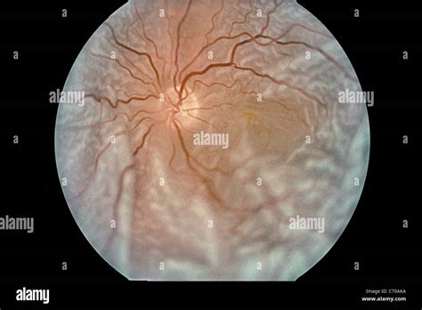 Retinal Detachment Stock Photo Alamy