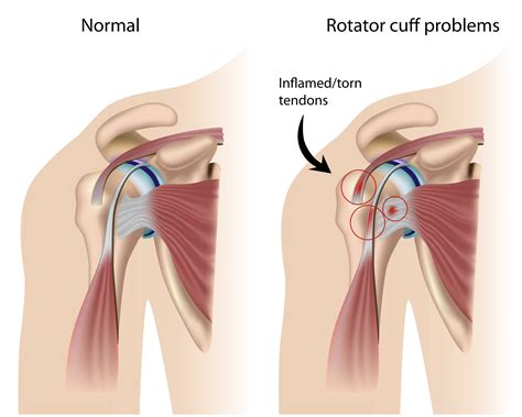 Shoulder anatomy shoulder injuries chicago westchester. 12 symptoms linked to right sided shoulder pain. - Broken Yogi