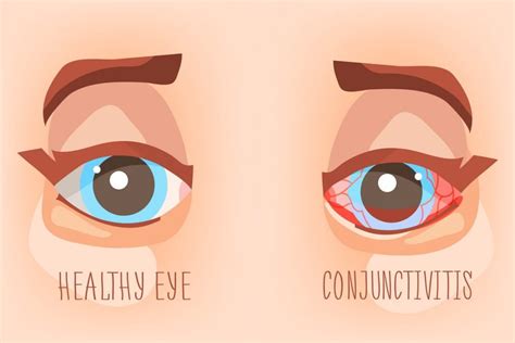 What Is Pink Eye Signs And Symptoms Dr Tavel