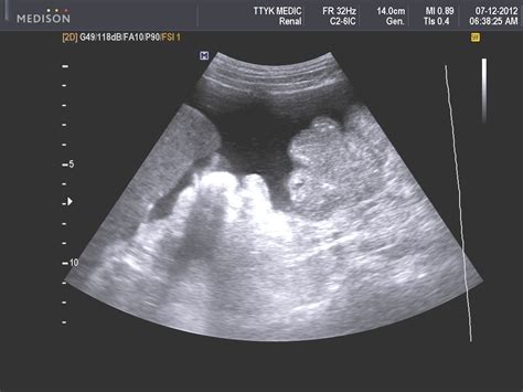 Malignant mesothelioma is a cancer of the thin tissue (mesothelium) that lines the lung, chest wall, and abdomen. VIETNAMESE MEDIC ULTRASOUND: CASE 164: ASCITES due to ...
