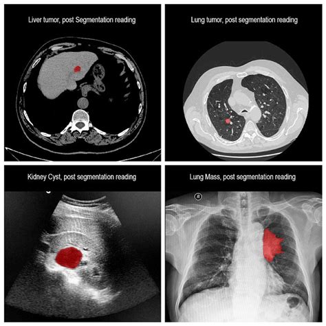 State Of The Art Medical Segmentation With Ai By Rsip Vision