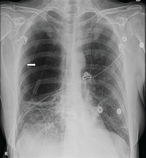 Look Before You Leap A Curious Case Of Giant Pulmonary Bulla Bmj