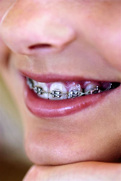 How To Make Your Own Fake Braces Pin By Beyourself Andlovelife On Love