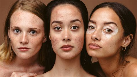 Hormonal Acne Explained Causes Symptoms And Treatments