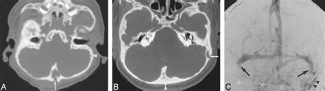 Prominent Basal Emissary Foramina In Syndromic Craniosynostosis