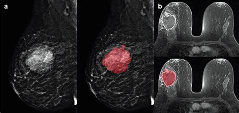 Ai Enhanced Breast Imaging Where Are We And Where Are We Heading
