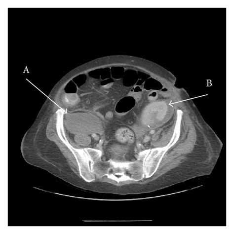 Ct Scan Showing Extensive Retroperitoneal Haemorrhage Involving Both