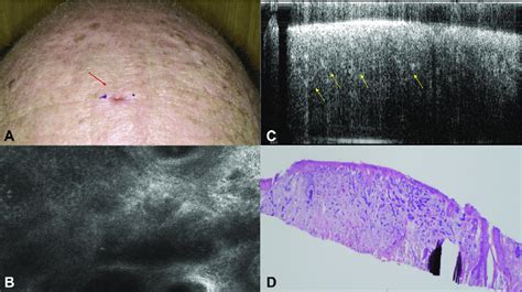 Basal Cell Carcinoma Bcc On The Forehead Noted As Superficial