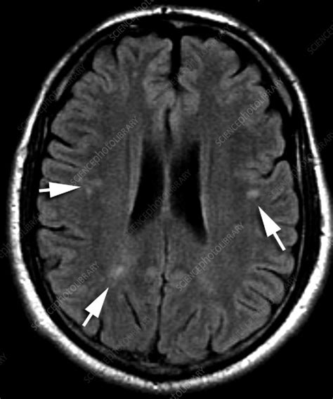 Migraine Mri Stock Image C039 3540 Science Photo Library