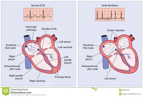 Conducción Eléctrica Del Corazón Normal Y Fibrilación Atrial