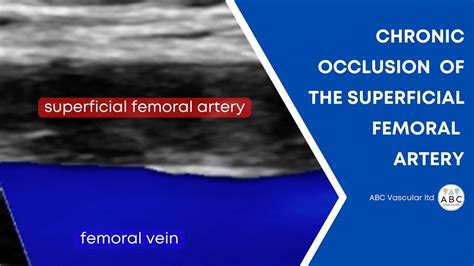Peripheral Doppler Test Chronic Occlusion Of The Superficial Femoral