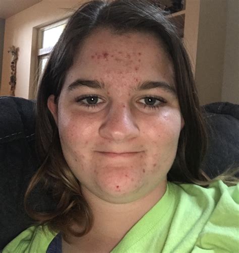Routine Help Help My Acne Is So Bad Looking For Natural Cruelty