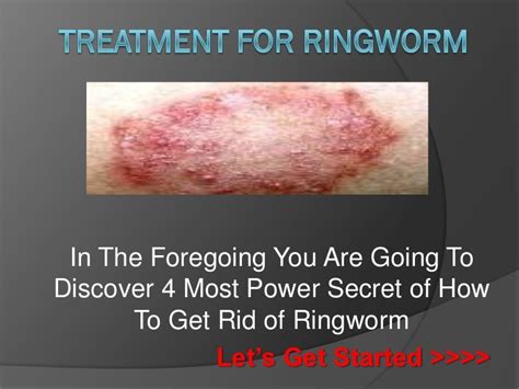 Treatment For Ringworm