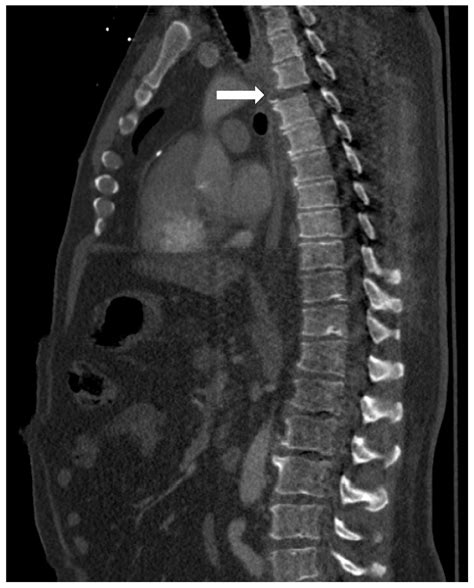 A Case Of A Traumatic Chyle Leak Following An Acute Thoracic Spine