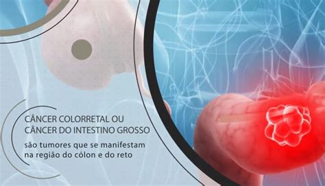 Câncer Colorretal Portal Da Coloproctologia