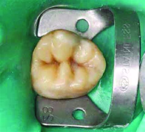 Clinical Appearance Of The Composite Resin Restoration Download