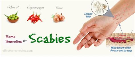 Top 20 Natural Home Remedies For Scabies Treatment In Humans