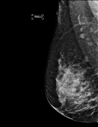 Breast Hamartoma Radiology Case Radiopaedia Org