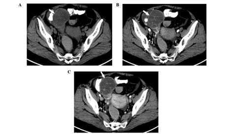 Ct Findings Of Sclerosing Stromal Tumor Of The Ovary A Report Of Two
