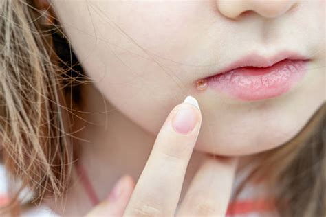 Pimple Lip Stock Photos Pictures And Royalty Free Images Istock