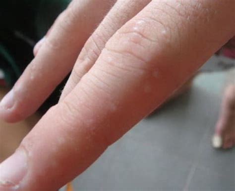 Dyshidrotic Eczema A Condition In Which Small Itchy Blisters Are