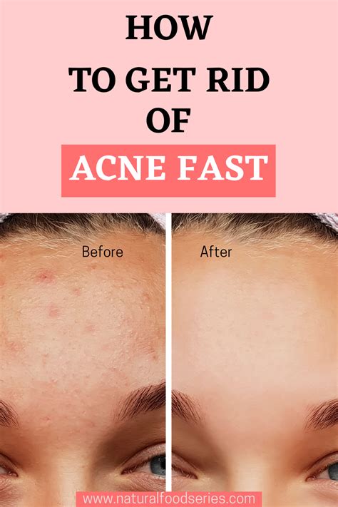 How To Get Rid Of Acne Fast In How To Get Rid Of Acne Clear Acne Fast Clear Skin Fast
